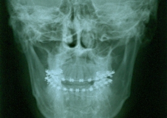 Telerradiografia frontal inicial - Clínica Cliniface