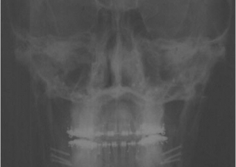 Telerradiografia frontal após a cirurgia - Clínica Cliniface