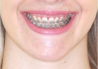 Sorriso após a cirurgia - Clínica Cliniface