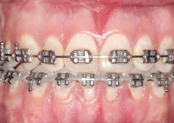 Mordida após a cirurgia - Clínica Cliniface
