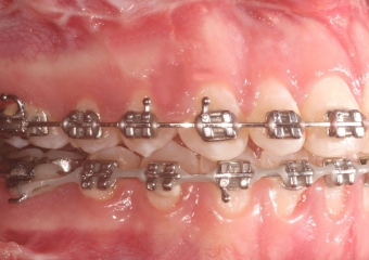 Mordida perfil após a cirurgia - Clínica Cliniface