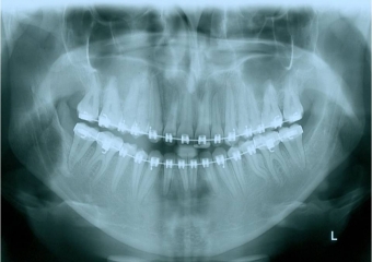 Raio x panorâmico inicial - Clínica Cliniface