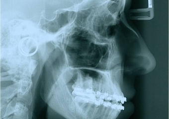 Telerradiografia de perfil inicial - Clínica Cliniface