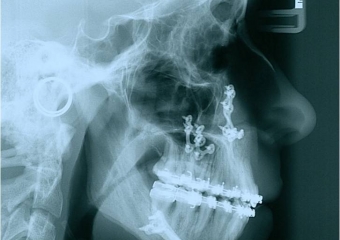 Telerradiografia de perfil após a cirurgia - Clínica Cliniface