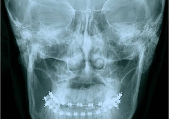 Telerradiografia frontal inicial - Clínica Cliniface