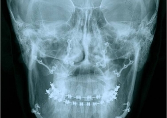Telerradiografia frontal após a cirurgia - Clínica Cliniface