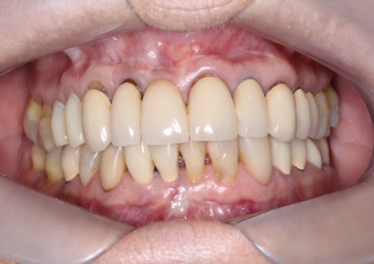 Foto intra oral frontal inicial  - Clínica Cliniface