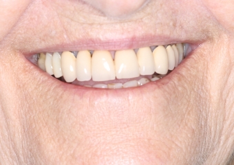 Foto extra oral frontal inicial  - Clínica Cliniface