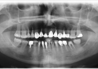 Rx Panorâmico inicial  - Clínica Cliniface