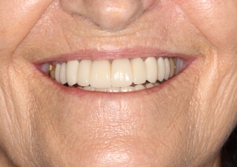 Foto intra oral frontal final 2019 - Clínica Cliniface