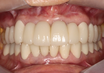 Foto intra oral final 2019 - Clínica Cliniface