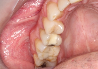 Elemento 15 fraturado - Clínica Cliniface