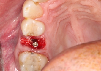 Implante -  Enxerto ósseo sintético - Clínica Cliniface