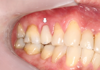 Provisório imediato - Clínica Cliniface