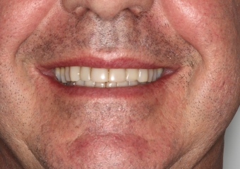 Foto extra oral frontal inicial - Clínica Cliniface