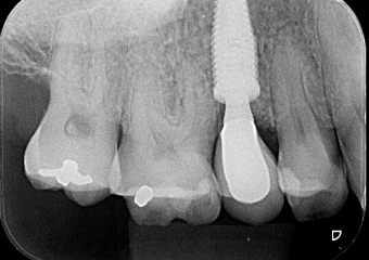 Rx final com dente definitivo - Clínica Cliniface