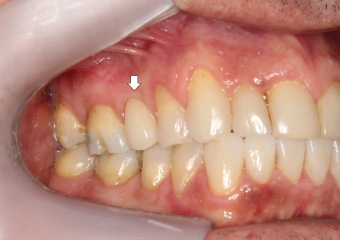 Dente definitivo - Clínica Cliniface