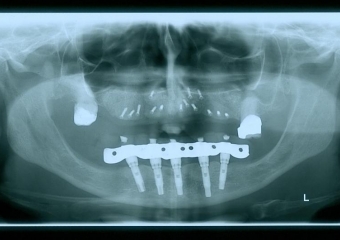 Raio x enxerto maxila, com osso autógeno e Bio Oss, em  2013 - Clínica Cliniface