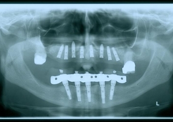 Raio x implantes superiores, em 2013 - Clínica Cliniface