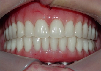 Prótese fixa inferior em resina instalada - Clínica Cliniface