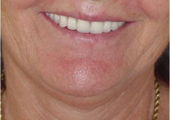 Sorriso final, do caso terminado em janeiro de 2014 - Clínica Cliniface