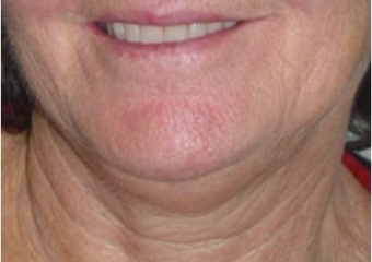 Sorriso inicial - Clínica Cliniface