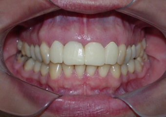 Imagens iniciais com dentes 11 e 25 comprometidos - Clínica Cliniface