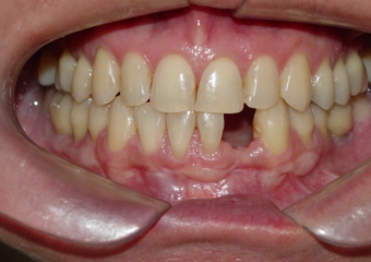 Imagem após extração do dente 32, devido a reabsorção radicular - Clínica Cliniface