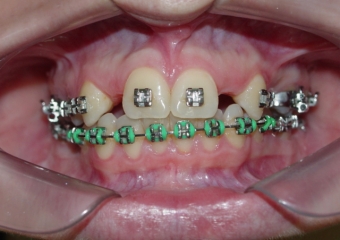 Imagem após extrações de dentes decíduos e instalação de um implante - Clínica Cliniface