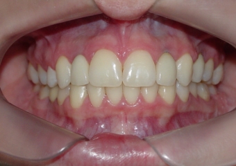 Próteses de porcelana sobre implantes - Clínica Cliniface