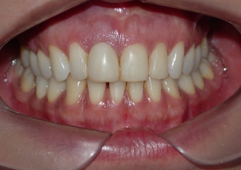 Imagem inicial de paciente com fratura de raiz no dente 11 - Clínica Cliniface