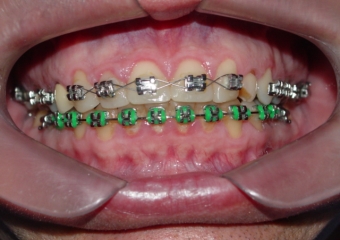 Imagem inicial com presença de canino decíduo - Clínica Cliniface