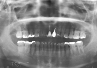 Raio X inicial - Clínica Cliniface