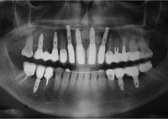 Raio x com próteses fixas em porcelana instaladas - Clínica Cliniface