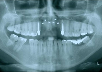 Raio x após enxerto ósseo - Clínica Cliniface
