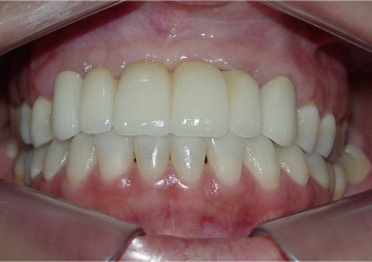 Próteses fixas em porcelana instaladas - Clínica Cliniface