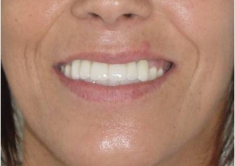 Sorriso final, do caso terminado em Novembro de 2013 - Clínica Cliniface