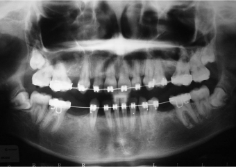 Raio x inicial, com agenesia de dentes permanentes - Clínica Cliniface