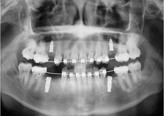 Raio após implantes instalados - Clínica Cliniface