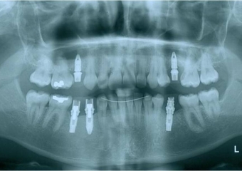 Raio x após dentes provisórios fixos instalados - Clínica Cliniface