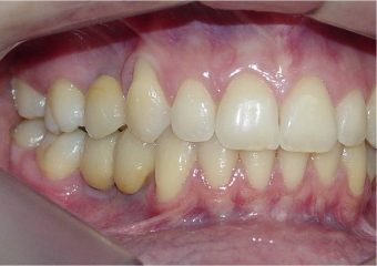 Dentes de porcelana instalados sobre implantes - Clínica Cliniface