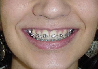 Sorriso inicial - Clínica Cliniface