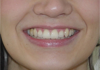 Sorriso final, do caso terminado em Julho de 2014 - Clínica Cliniface