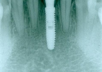 Raio x após extração e instalação do implante e dente provisório imediato - Clínica Cliniface