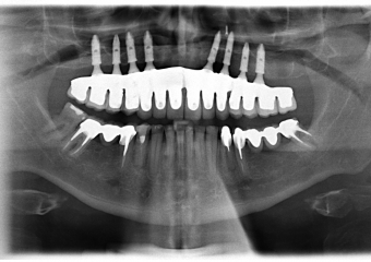 Raio X com prótese em porcelana com dentes individuais instalada - Clínica Cliniface