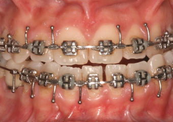 Mordida inicial - Clínica Cliniface