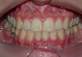 Mordida final - Clínica Cliniface