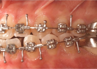 Mordida perfil inicial - Clínica Cliniface