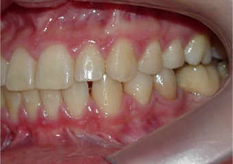 Mordida perfil final - Clínica Cliniface