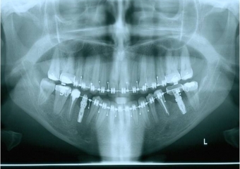 Raio x panorâmico inicial - Clínica Cliniface